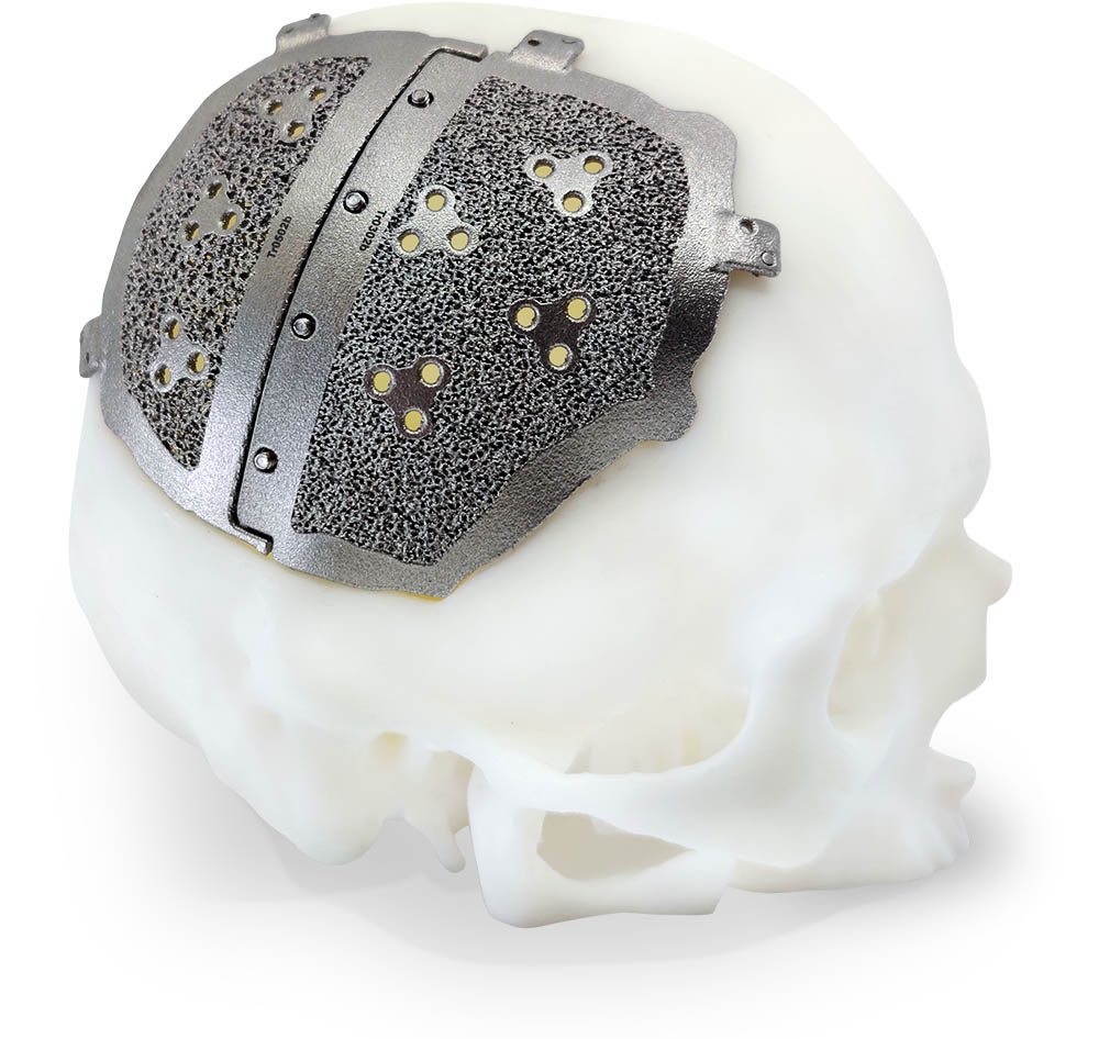 Cranial implant