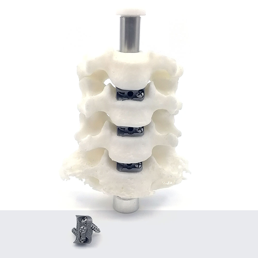 Custom spinal cage