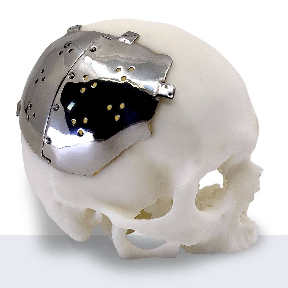 Custom Cranial implant